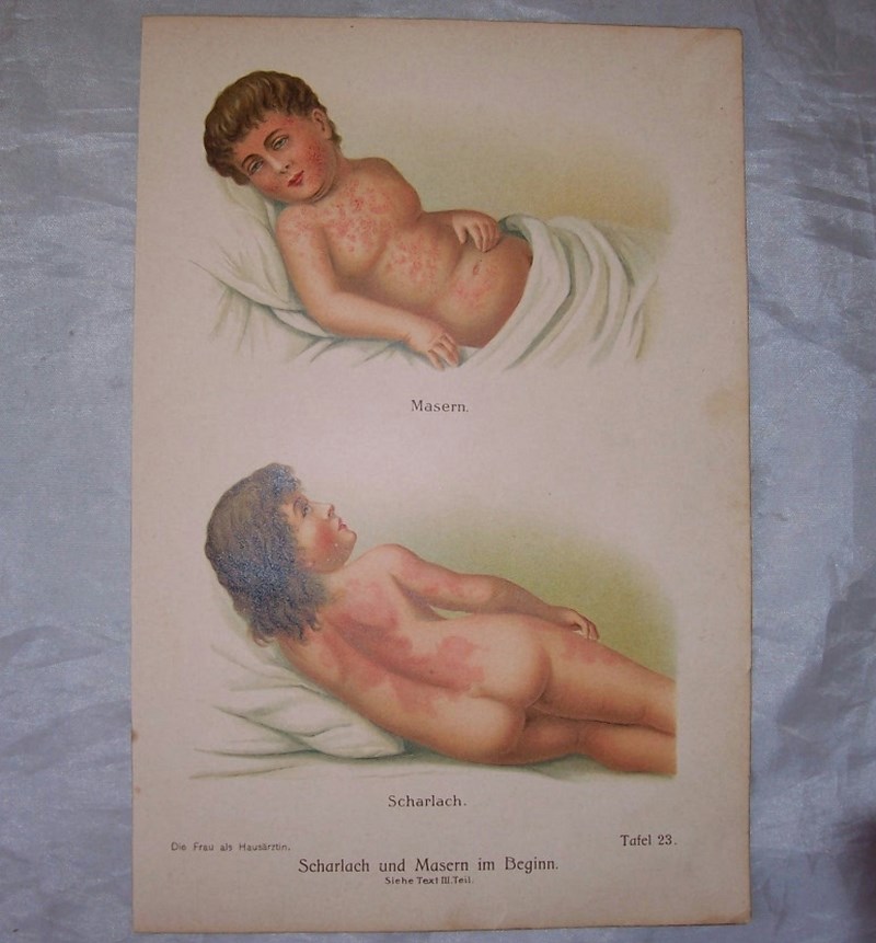 OBJAWY SZKARLATYNY I ODRY. GRAFIKA. 1905.