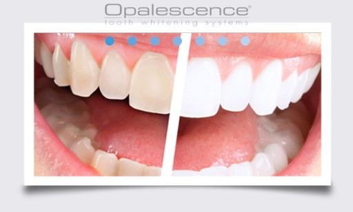 OPALESCENCE GO_READY НАКЛАДЫВАЕТСЯ С GEL_SELECTED. ЗУБ